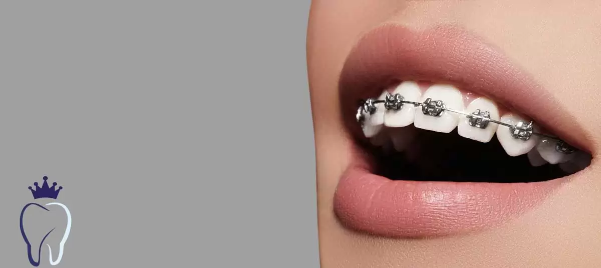 برای داشتن دندان های صاف روکش دندان یا ارتودنسی شفاف، کدام یک را ترجیح می دهید؟