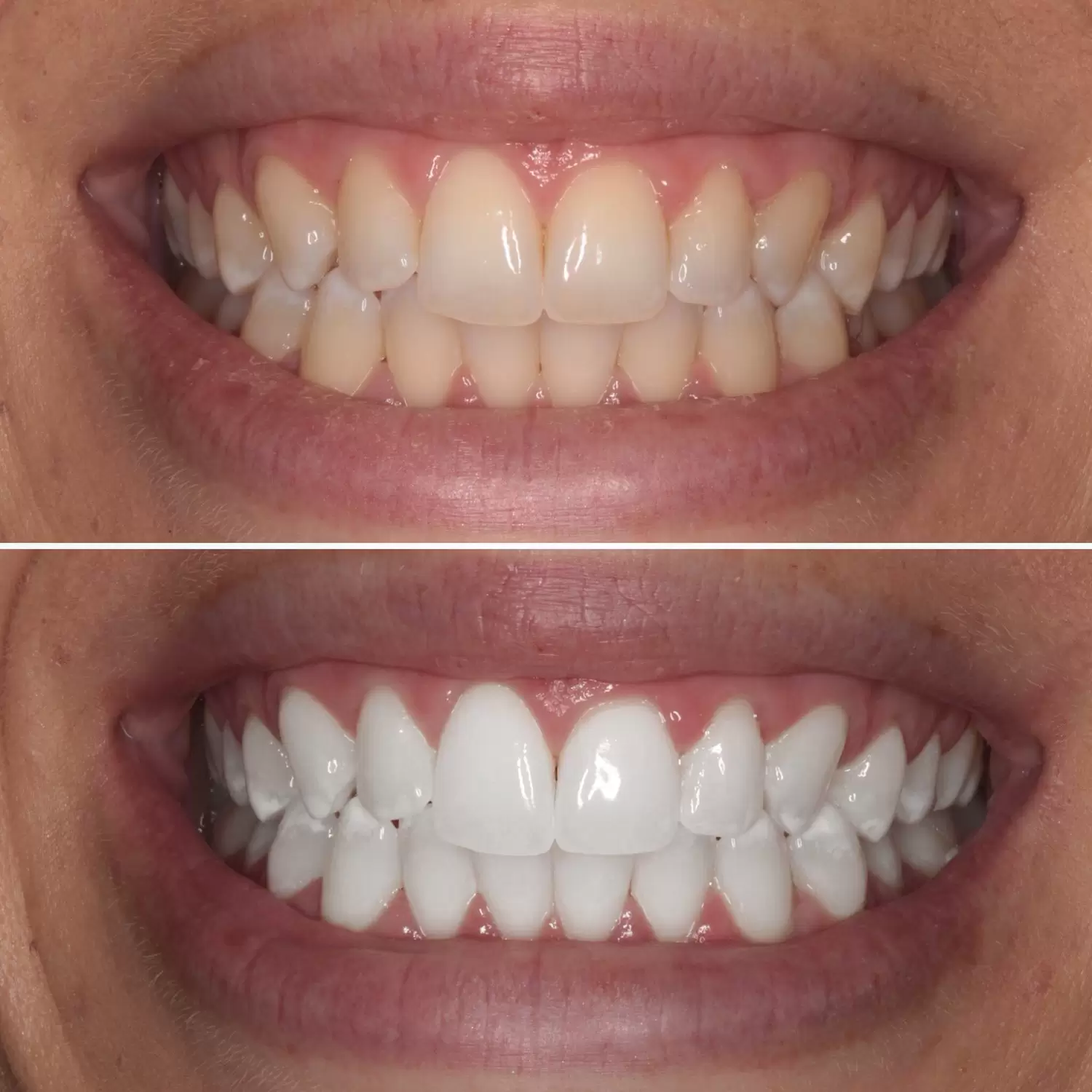 قبل و پس از درمان سفیدکردن دندان ها