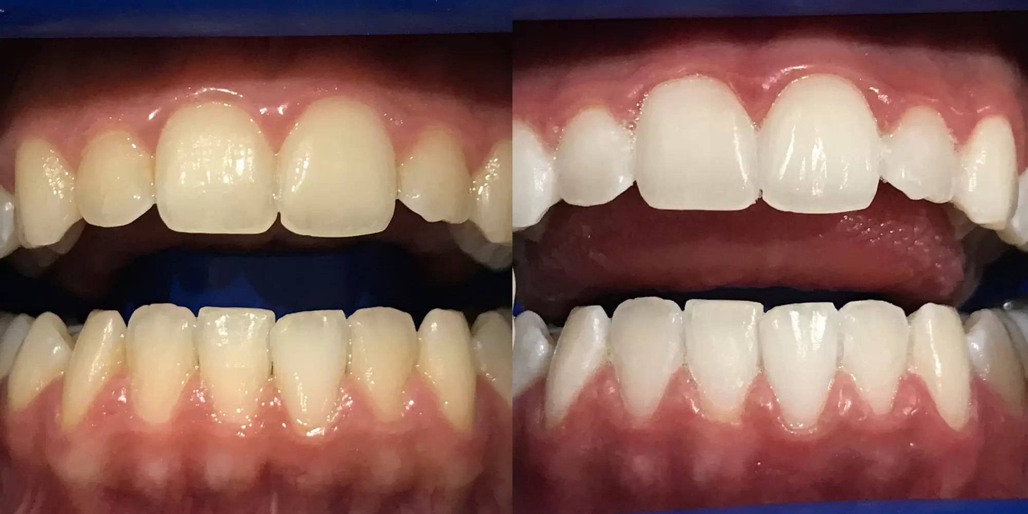 سفیدکردن دندان ها قبل و بعد و درمان