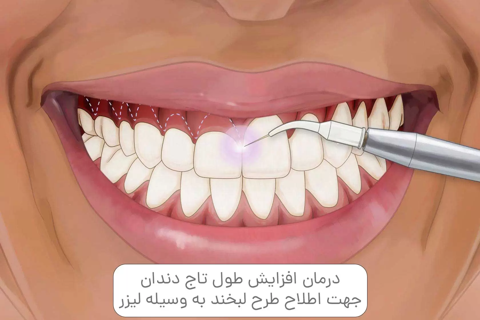 درمان افزایش طول تاج دندان جهت اطلاح طرح لبخند به وسیله لیزر