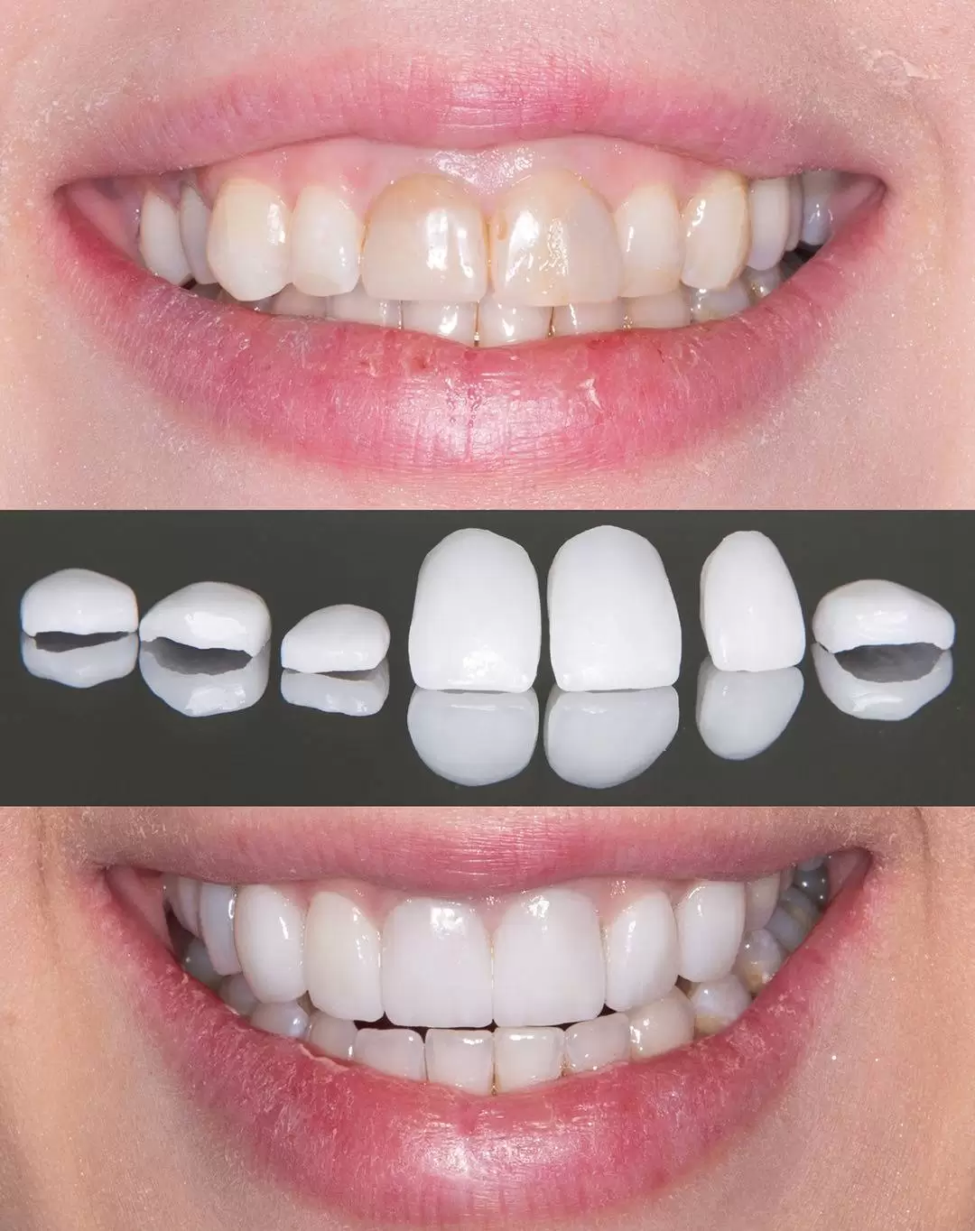 قبل و پس از درمان روکش دندان