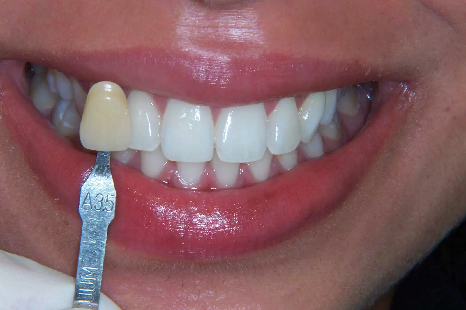 دندان A3 رنگ طبیعی دندان با توجه به سایه ها