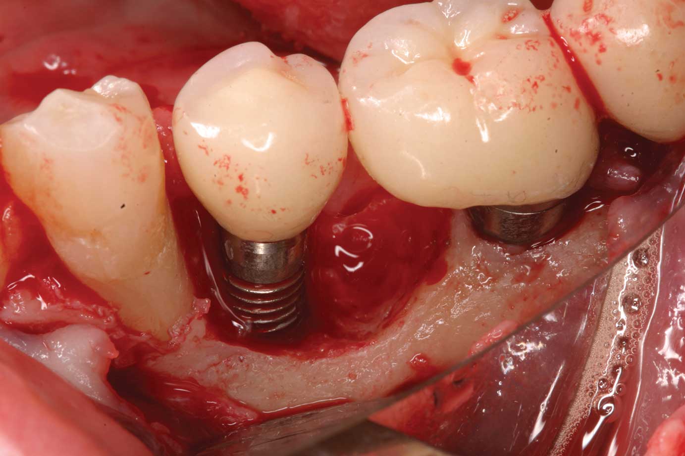 عوارض کاشت دندان