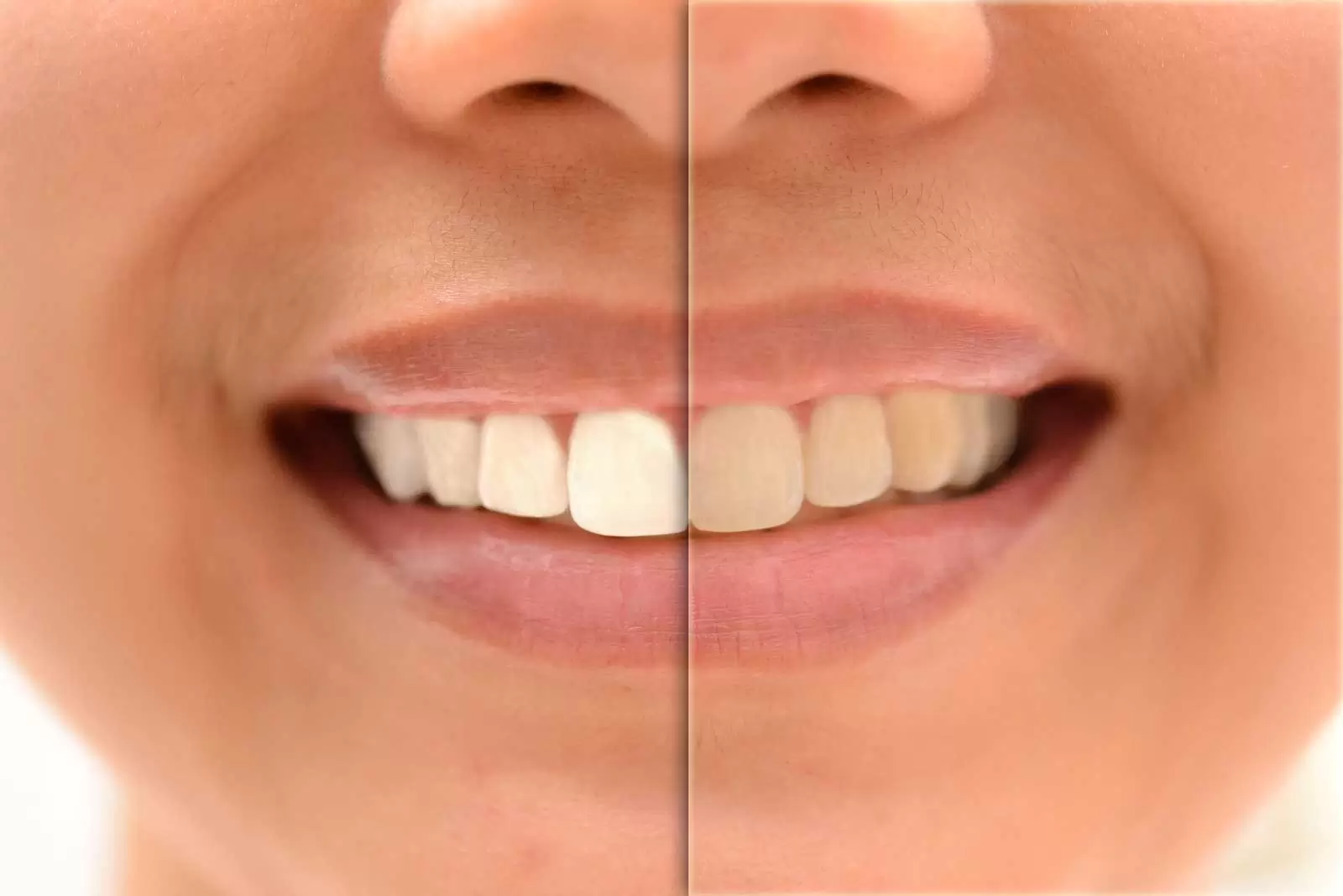 قبل و پس از بلیچینگ دندان