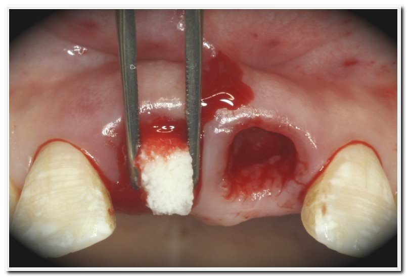 سفیدی محل کشیده شدن دندان در ناحیه دندان کشیده شده
