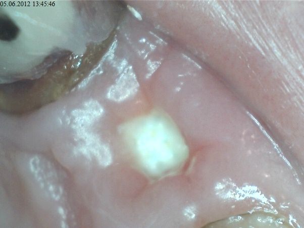 بافت سفید در ناحیه دندان کشیده شده