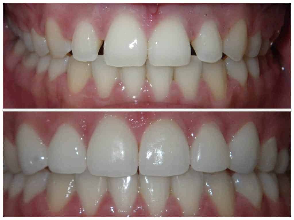 قبل و بعد درمان روکش دندان