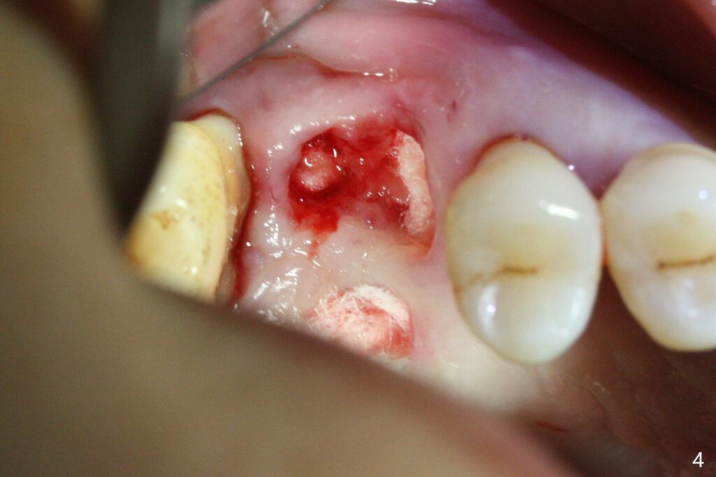 سفید شدن بافت دهدان در ناحیه کشیده شدن دندان