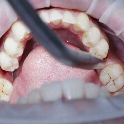 کاشت دندان و بررسی فک