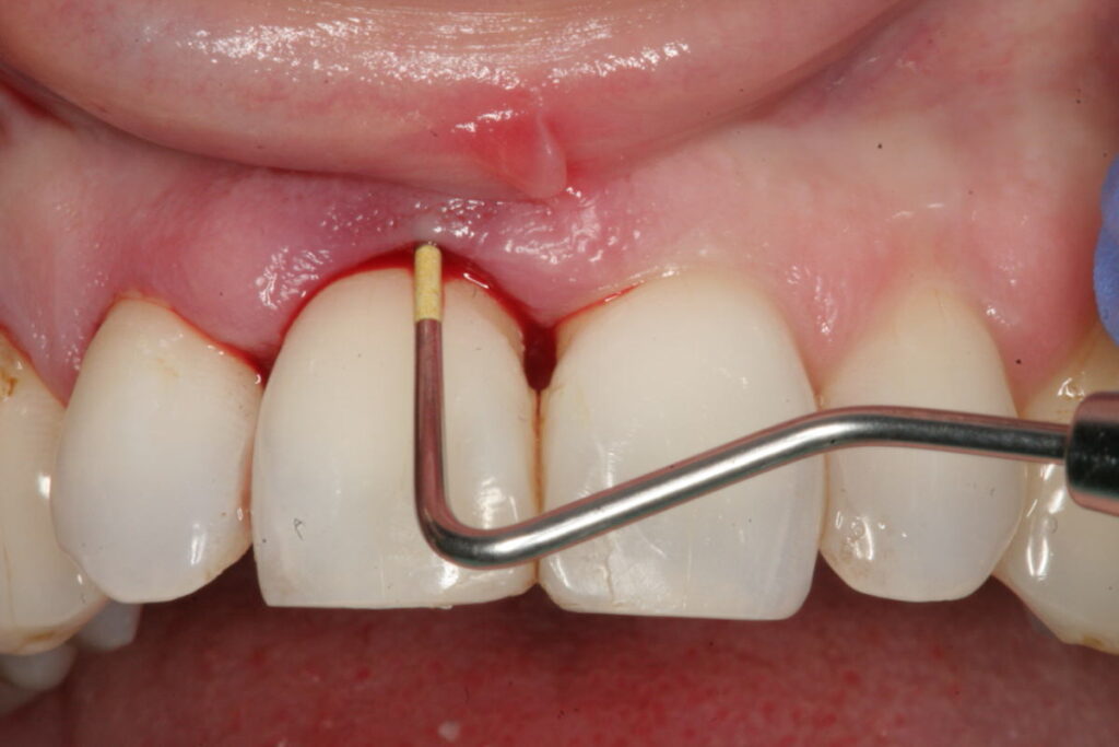 آبسه شدید دندان