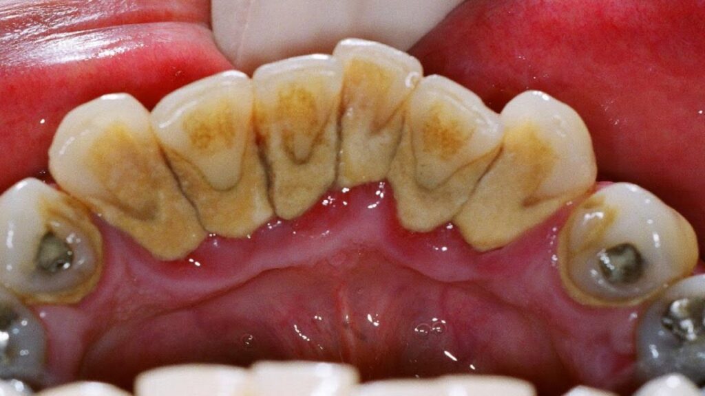 تارتار دندان