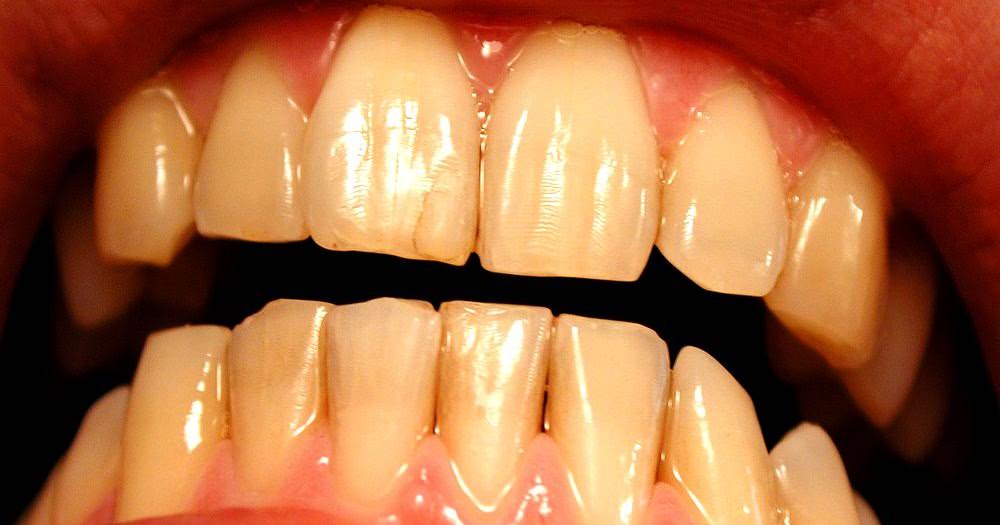 زردی دندان در اثر پیری زودرس دندان ها