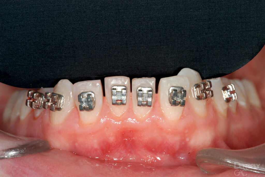 نیاز به تراش دندان در بیمار با مشکل ارتودنسی
