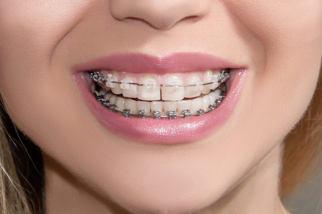 تراش دندان روشی مورد استفاده در ارتودنسی است