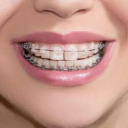 تراش دندان روشی مورد استفاده در ارتودنسی است