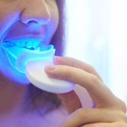 سوختگی لثه در سفید کردن دندان