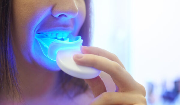 سوختگی لثه در سفید کردن دندان