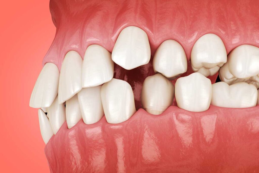 نصویر سه بعدی ازدحام دندان