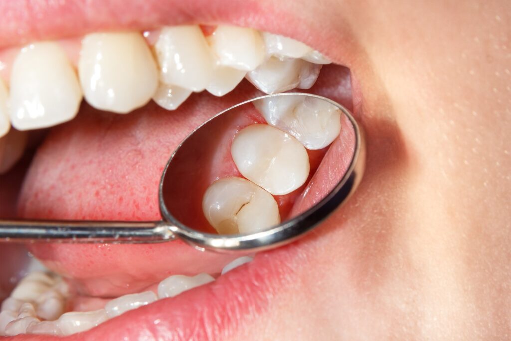 Enamel Dental Fillings Penticton Dentist
