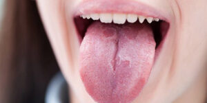 درمان زخم زبان در خانه