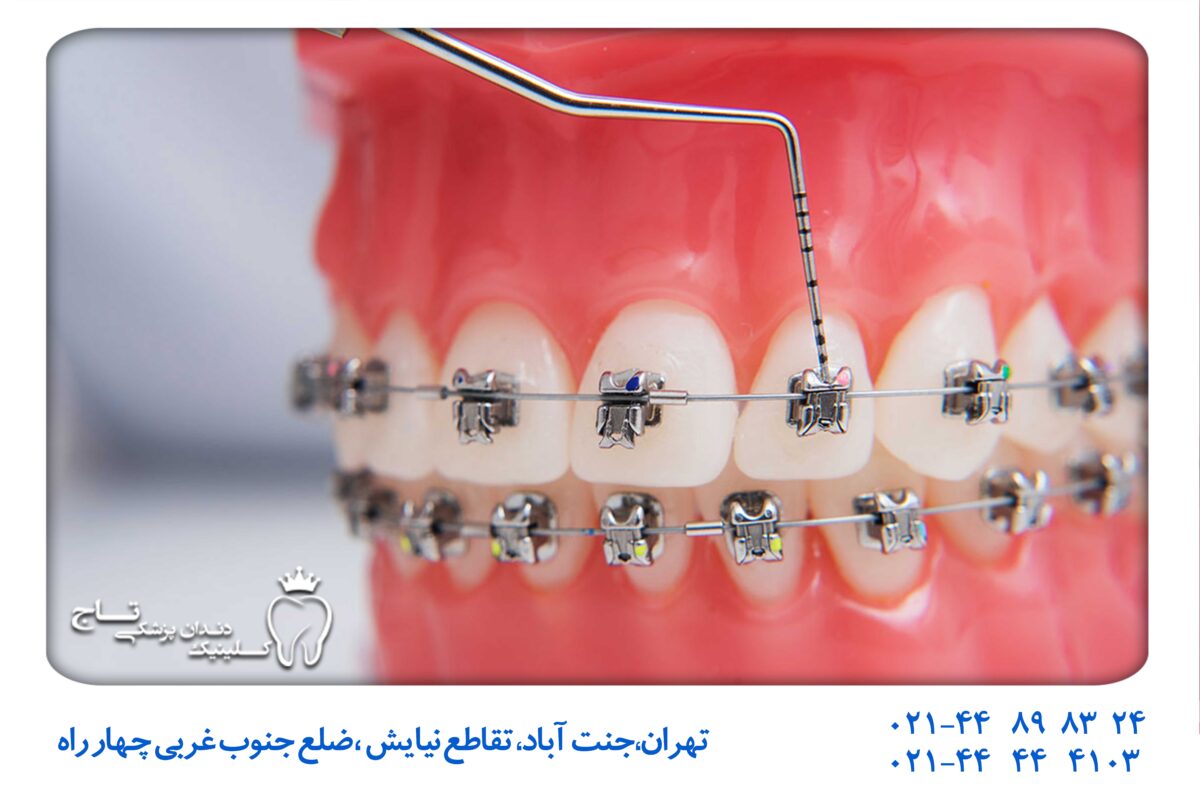عکس سیم فلزی دندان