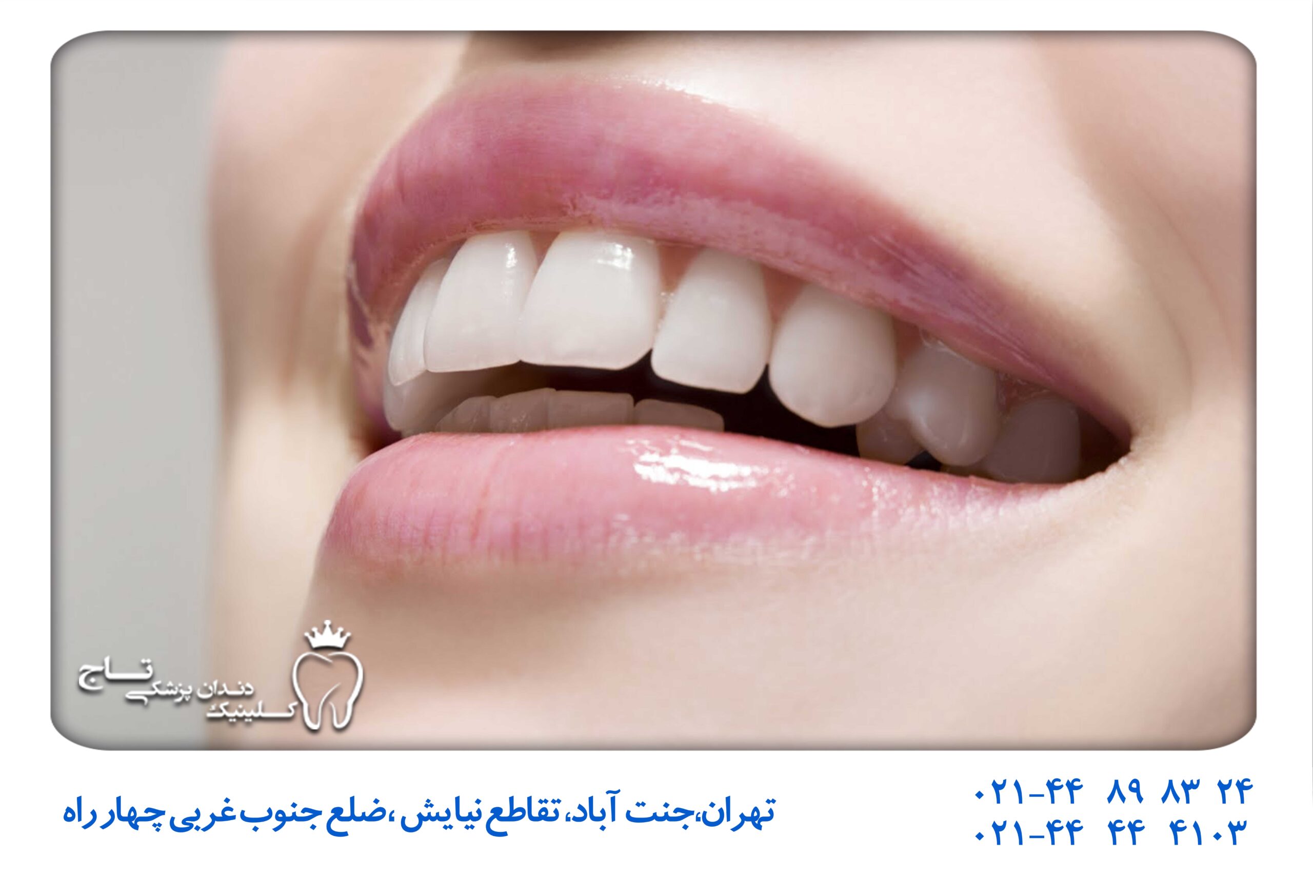 کانتورینگ دندان