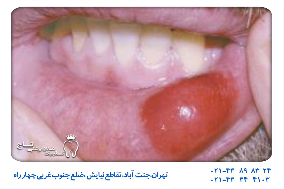 علل تشکیل لخته خون دهان