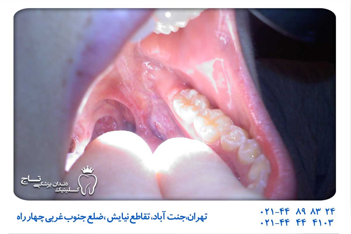 عکس التهاب کام دهان