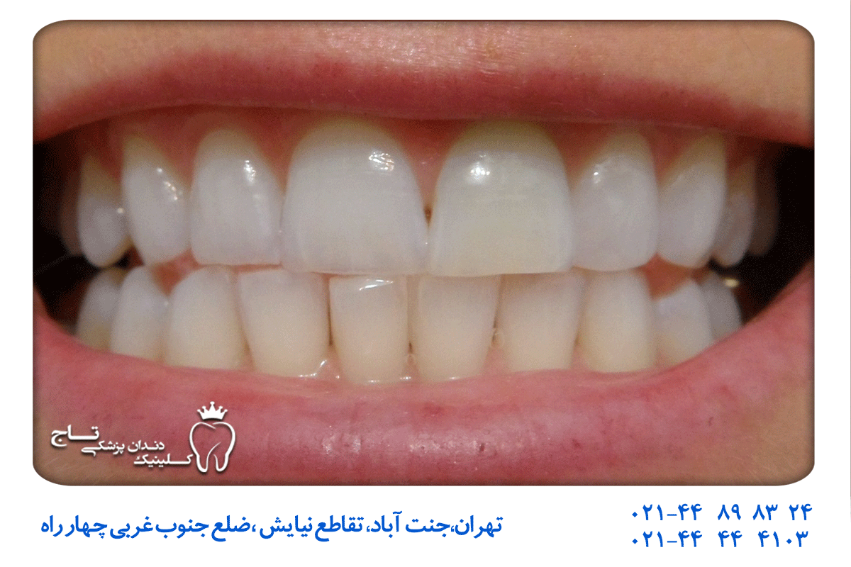 سفید کردن سریع دندان