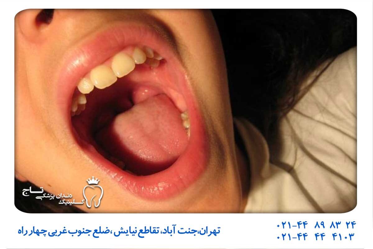 درمان التهاب کام دهان