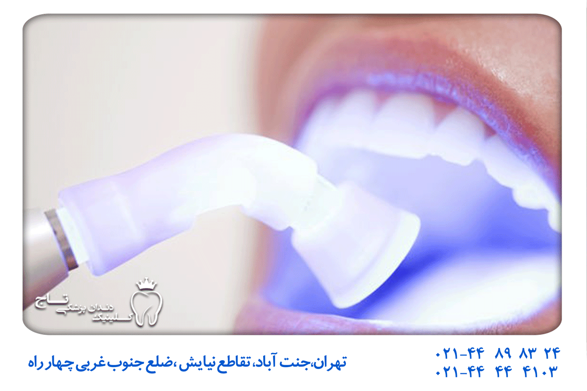 سفید کردن سریع دندان