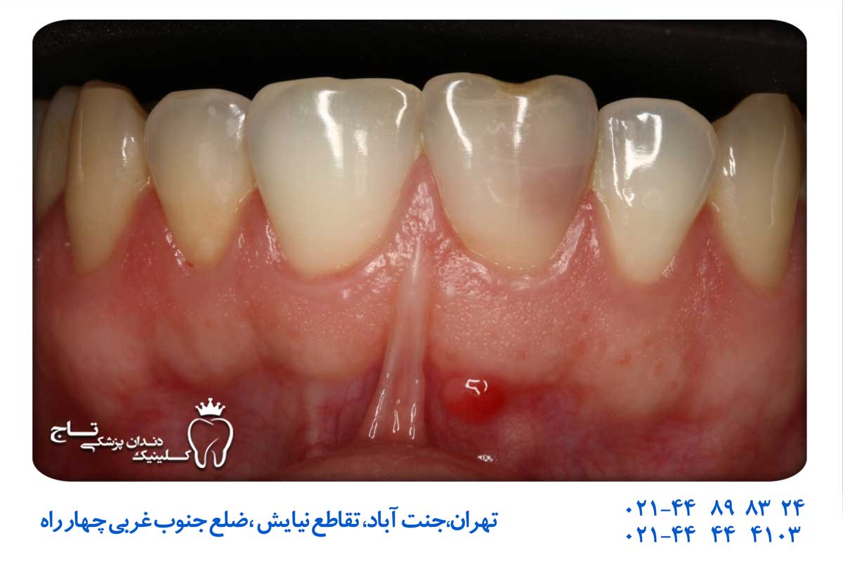 درمان خانگی فیستول دندان