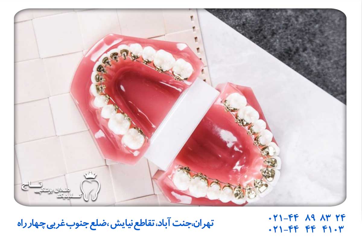 عکس ارتودنسی پشت دندانی