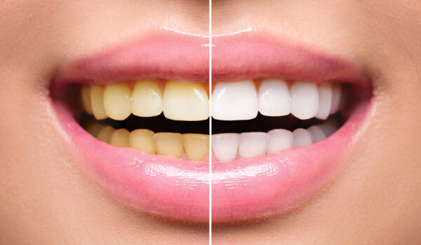 teeth whitening 2020 01 13 5e1c4987231c6