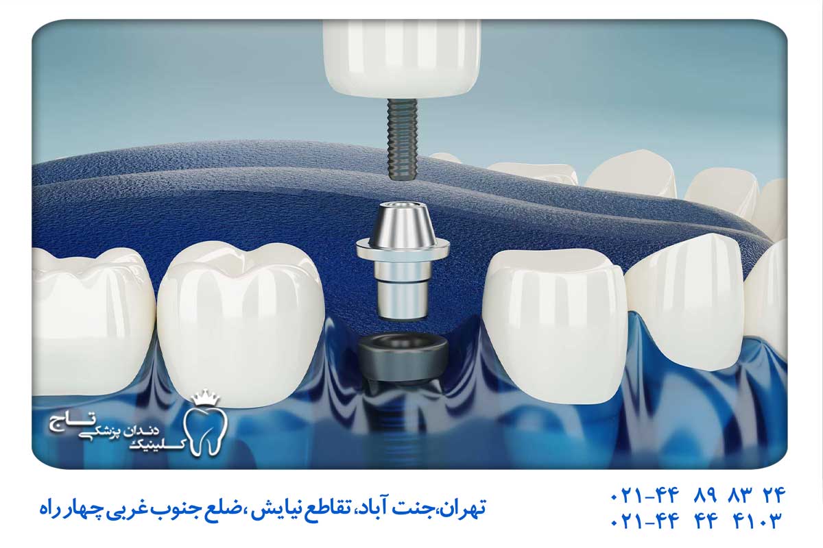 ایمپلنت تخصصی دندان در تهران
