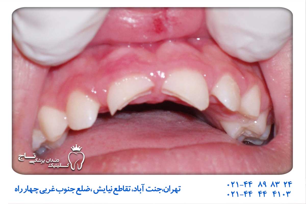 عکس اورژانس دندانپزشکی اطفال