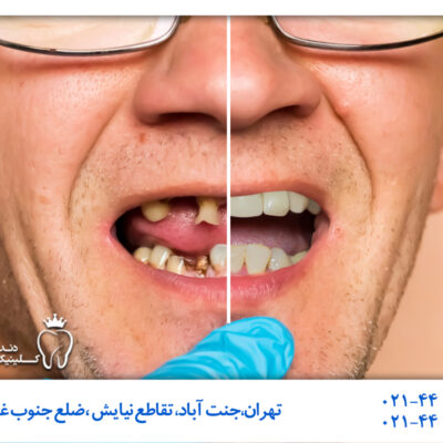 درمان سریع بی دندانی
