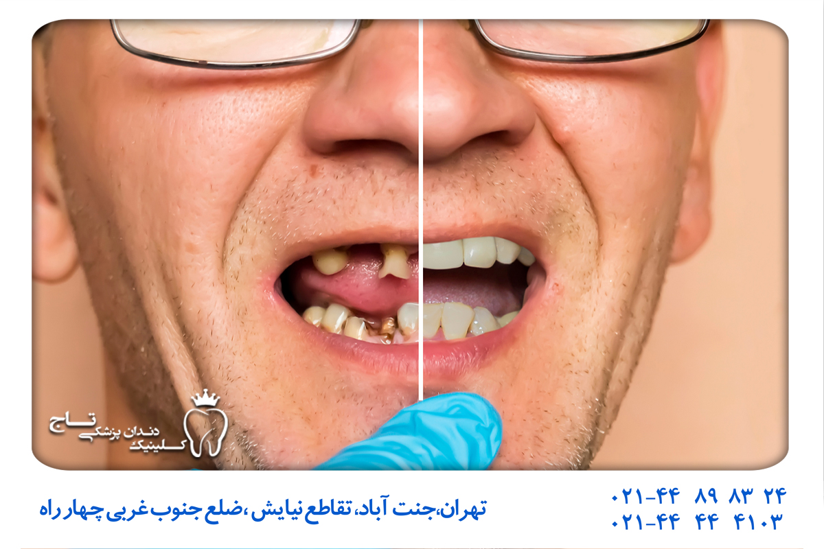 درمان سریع بی دندانی