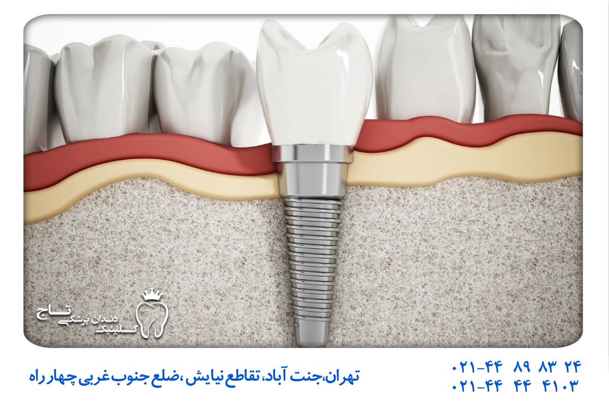 ظهور گزینه‌های درمان سریع بی دندانی