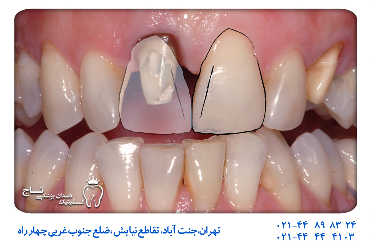 مزایای طراحی لبخند در کلینیک دندانپزشکی تاج