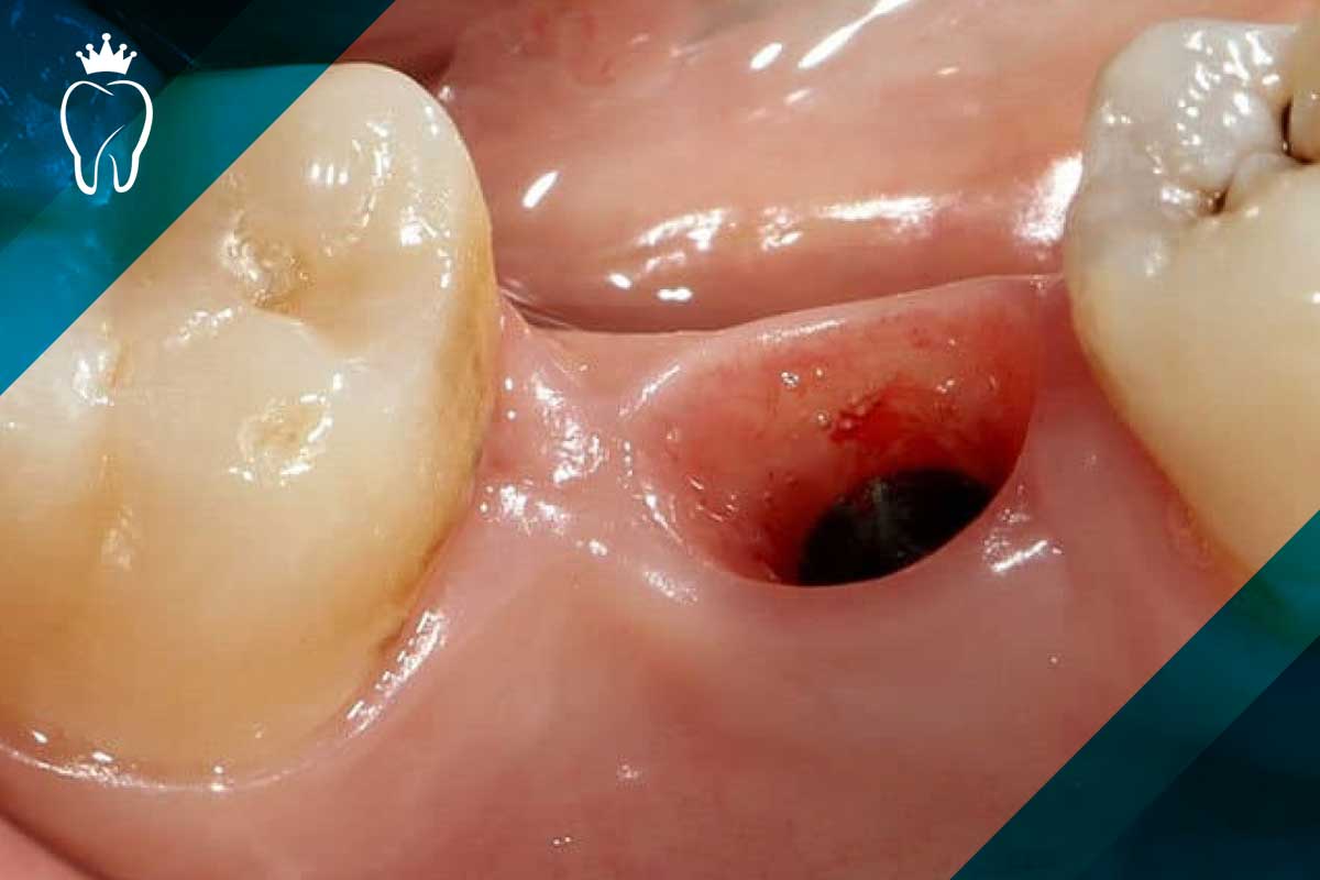 علل حباب های خون در دهان