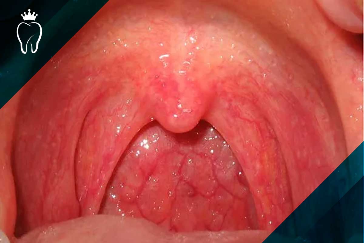 علائم التهاب کام دهان 