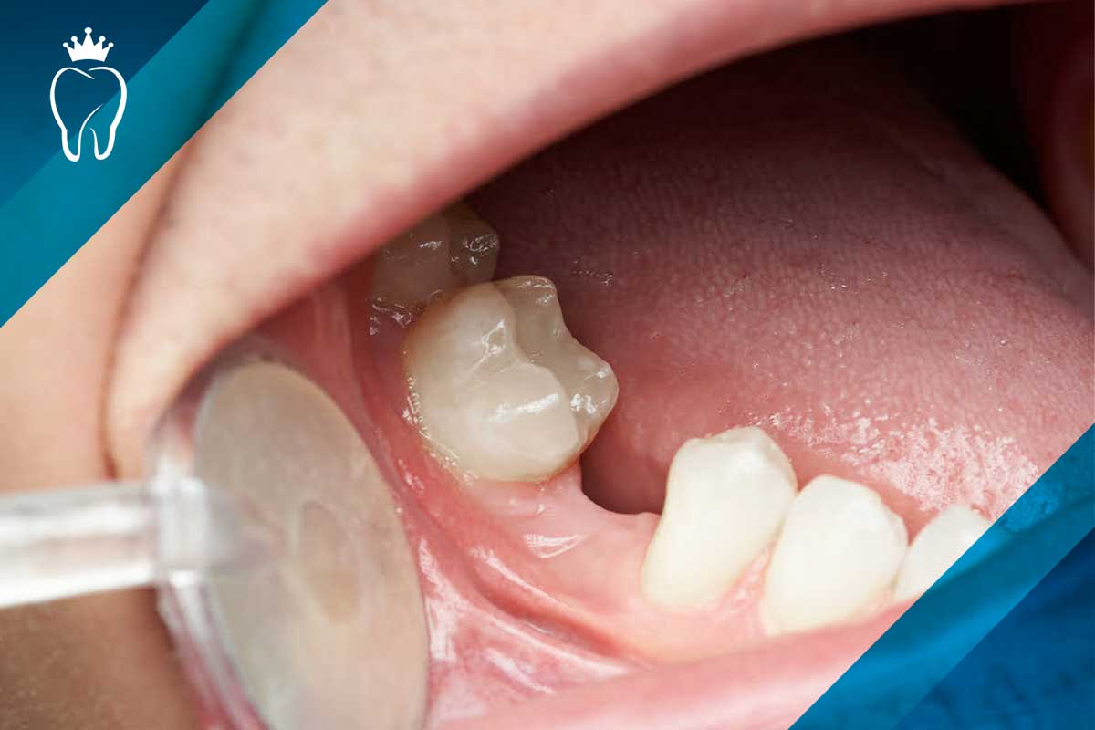 علت سفید شدن جای دندان کشیده شده