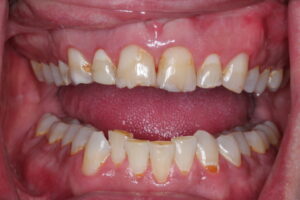 جلوگیری از فرسایش اسیدی دندان