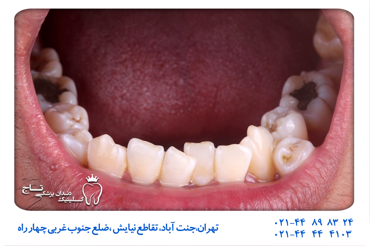 انواع هایپردونتیا