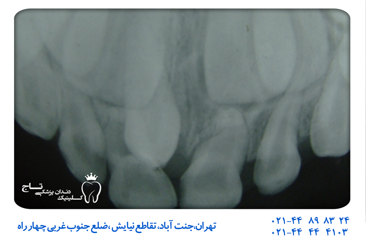 علائم و تشخیص هایپردونتیا