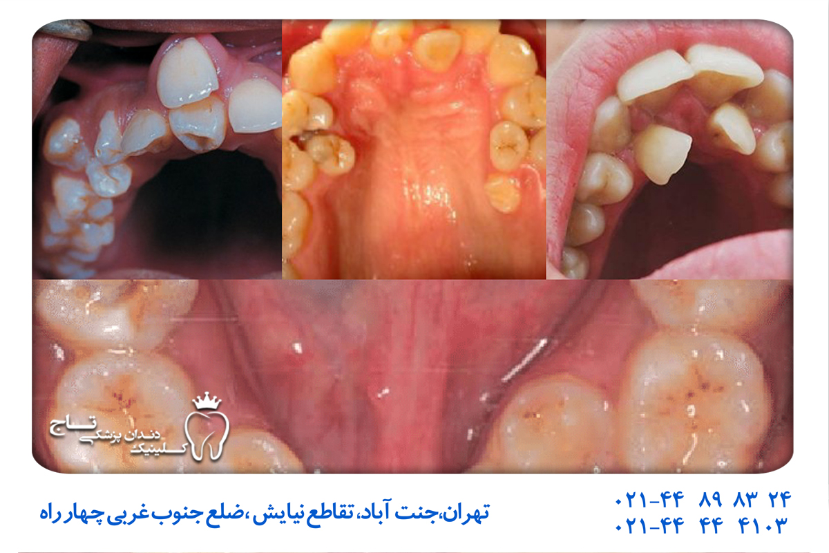 اقدامات پیشگیرانه برای هایپردونتیا