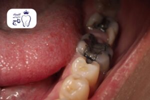 عفونت دندان عصب کشی شده