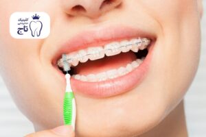 مسواک ارتودنسی