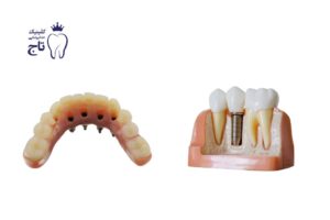 فرق اوردنچر با ایمپلنت